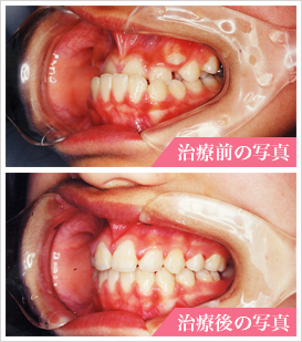 うけ口の治療写真