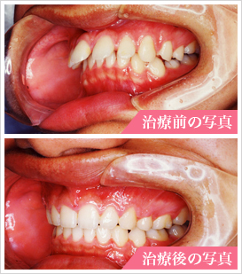 出っ歯の治療写真